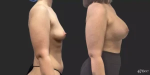 Breast Augmentation #65, before and after photo, view 2
