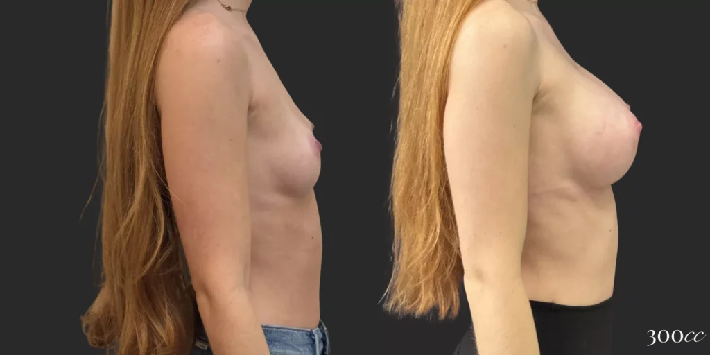 Breast Augmentation #063, before and after photo, view 3