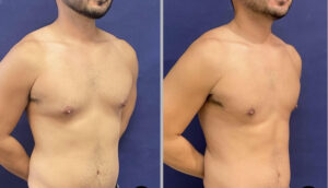 Liposuction #19, before and after photo, view 2