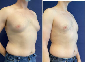 Liposuction #20, before and after photo, view 2