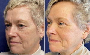 Eyelid Lift #011, before and after photo, view 2