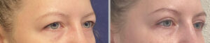 Eyelid Lift #010, before and after photo, view 2