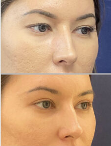 Eyelid Lift #009, before and after photo, view 2