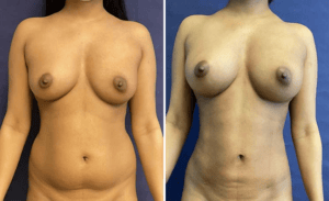 Lipo Breast Augmentation #001, before and after photo