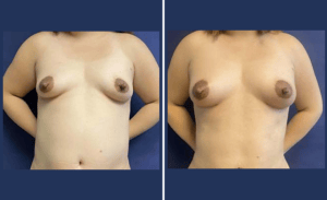 Lipo Breast Augmentation #002, before and after photo
