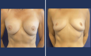 Breast Implant Removal #01, before and after photo