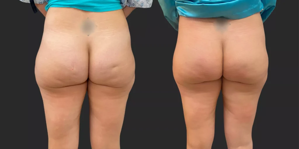 Avéli Cellulite Reduction #002, before and after photo