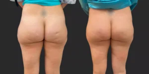 Avéli Cellulite Reduction #002, before and after photo