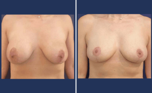 Breast Implant Removal #02, before and after photo