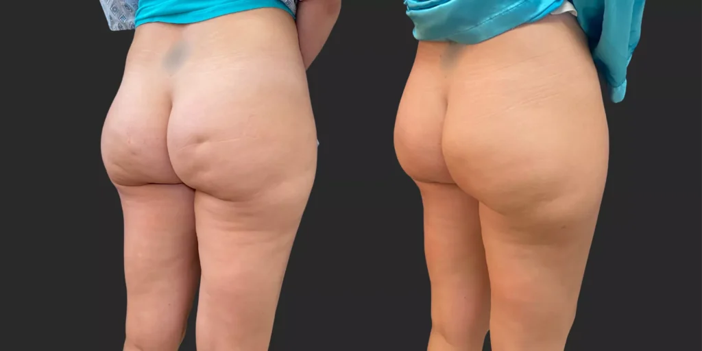 Avéli Cellulite Reduction #002, before and after photo, view 2