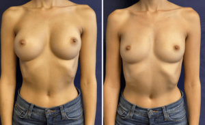Breast Implant Removal #03, before and after photo