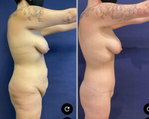 Tummy Tuck #012, before and after photo, view 2