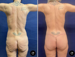 Tummy Tuck #011, before and after photo, view 2