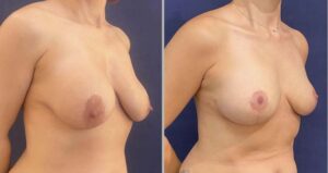Breast Implant Removal #02, before and after photo, view 2