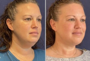 Face & Neck Lift #003, before and after photo, view 2
