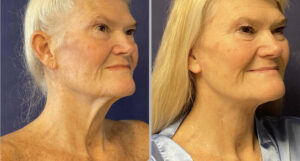 Face & Neck Lift #005, before and after photo, view 2