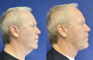 Face & Neck Lift #002, before and after photo