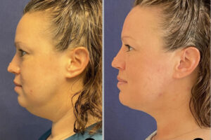 Face & Neck Lift #003, before and after photo