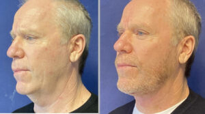 Face & Neck Lift #002, before and after photo, view 2