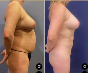 Liposuction #22, before and after photo, view 2