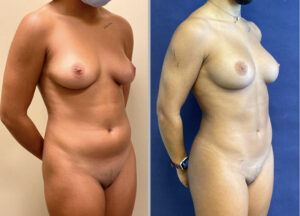 Liposuction #23, before and after photo, view 2