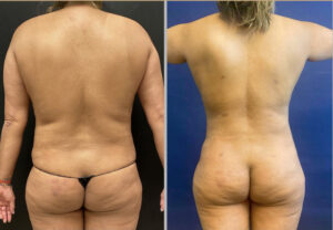 Liposuction #21, before and after photo, view 2