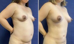 Lipo Breast Augmentation #002, before and after photo, view 2
