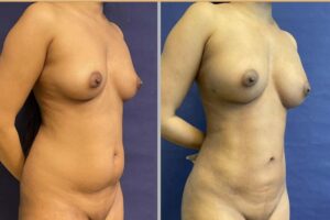 Lipo Breast Augmentation #001, before and after photo, view 2