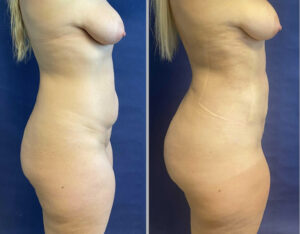 S.A.F.E. Liposuction with BBL #001, before and after photo, view 2