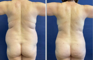 S.A.F.E. Liposuction with BBL #002, before and after photo, view 2