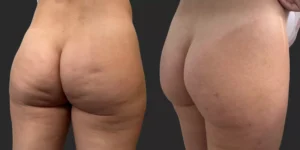 Avéli Cellulite Reduction #001, before and after photo