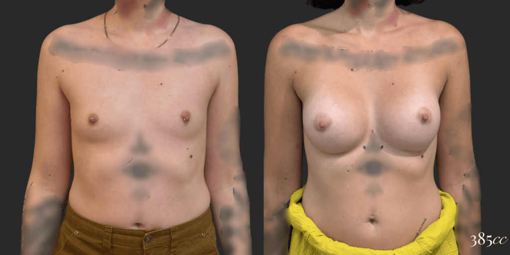 Breast Augmentation #67, before and after photo