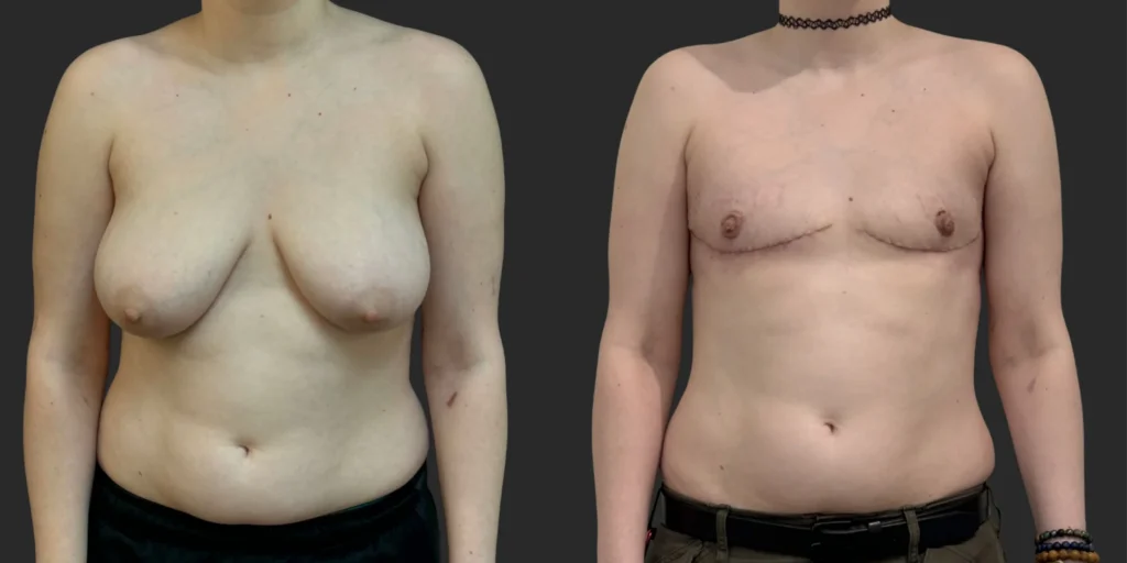Gender Affirming Top Surgery #010, before and after photo