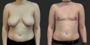 Gender Affirming Top Surgery #010, before and after photo