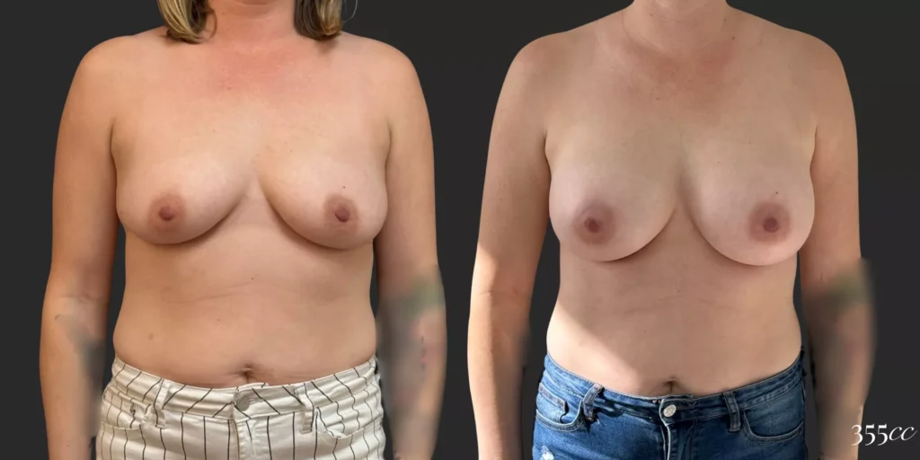 Breast Augmentation #68, before and after photo