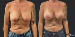 Breast Augmentation #69, before and after photo