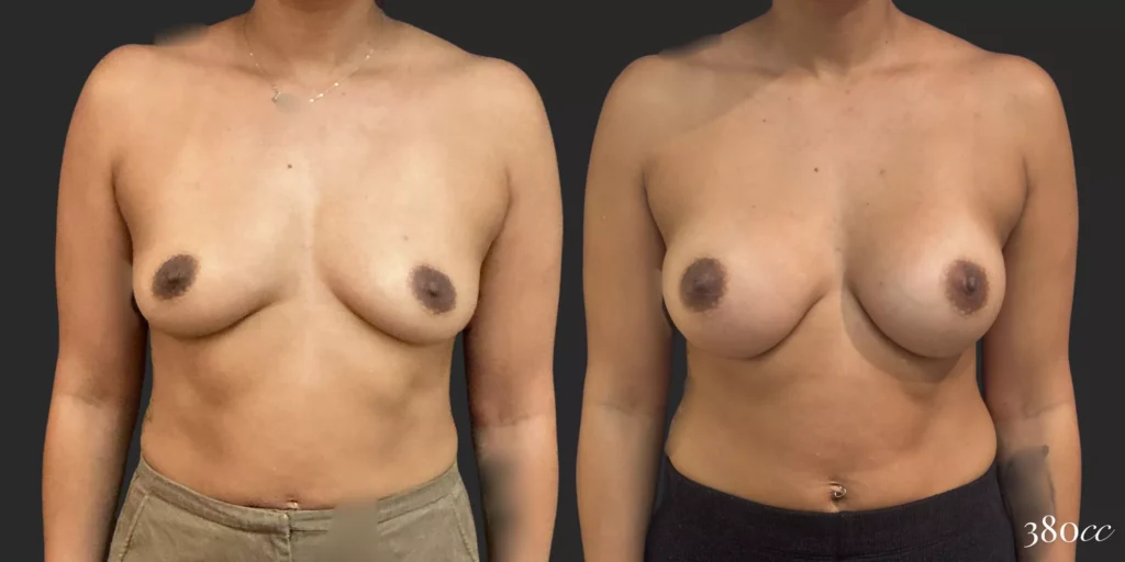 Breast Augmentation #70, before and after photo