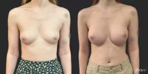 Breast Augmentation #71, before and after photo