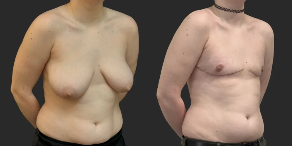 Gender Affirming Top Surgery #010, before and after photo, view 2