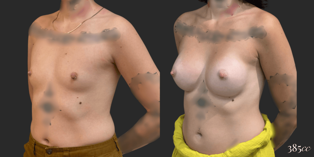 Breast Augmentation #67, before and after photo, view 3