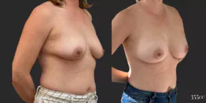 Breast Augmentation #68, before and after photo, view 2