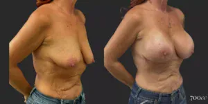 Breast Augmentation #69, before and after photo, view 2