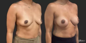 Breast Augmentation #70, before and after photo, view 2