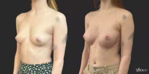 Breast Augmentation #71, before and after photo, view 2