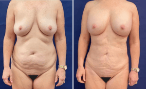 Implant Exchange & Liposuction #24, before and after photo