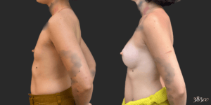 Breast Augmentation #67, before and after photo, view 2