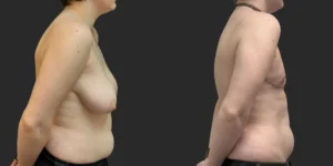 Gender Affirming Top Surgery #010, before and after photo, view 3