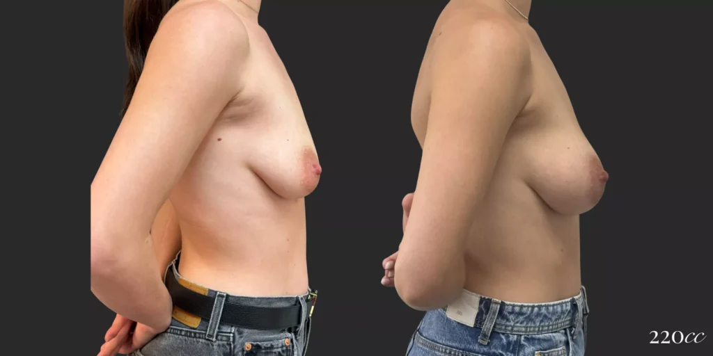 Breast Augmentation #66, before and after photo, view 3