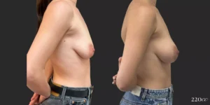 Breast Augmentation #66, before and after photo, view 3