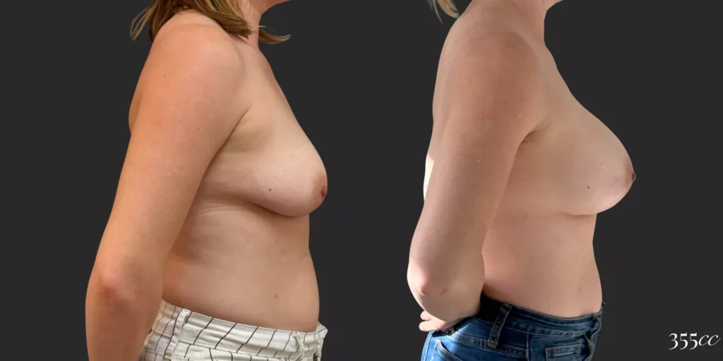 Breast Augmentation #68, before and after photo, view 3